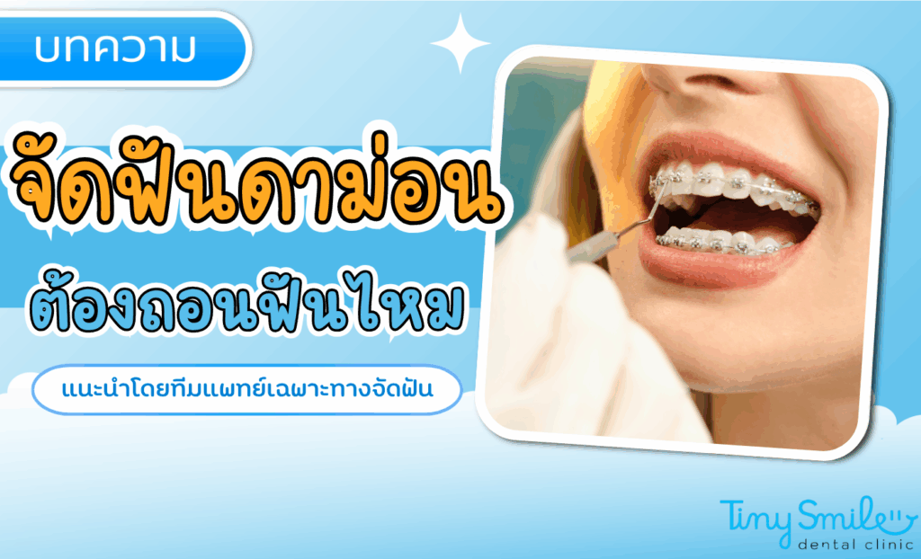 จัดฟันดาม่อน ต้องถอนฟันไหม