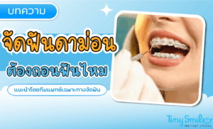 จัดฟันดาม่อน ต้องถอนฟันไหม