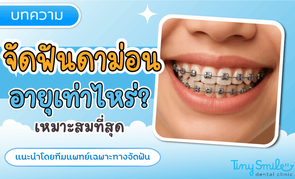 จัดฟันดาม่อน อายุเท่าไรเหมาะ คู่มือสั้นๆ ที่พ่อแม่ควรรู้ก่อนตัดสินใจ