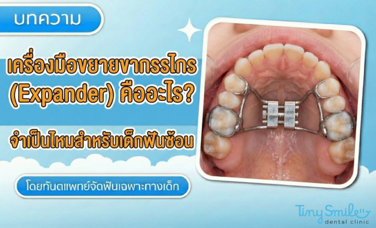 เครื่องมือขยายขากรรไกร (Expander) คืออะไร จำเป็นไหมสำหรับเด็กฟันซ้อน