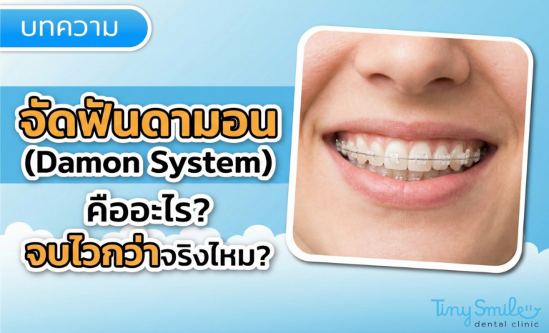 จัดฟันดามอน (Damon System) คืออะไร จบไวกว่าจริงไหม