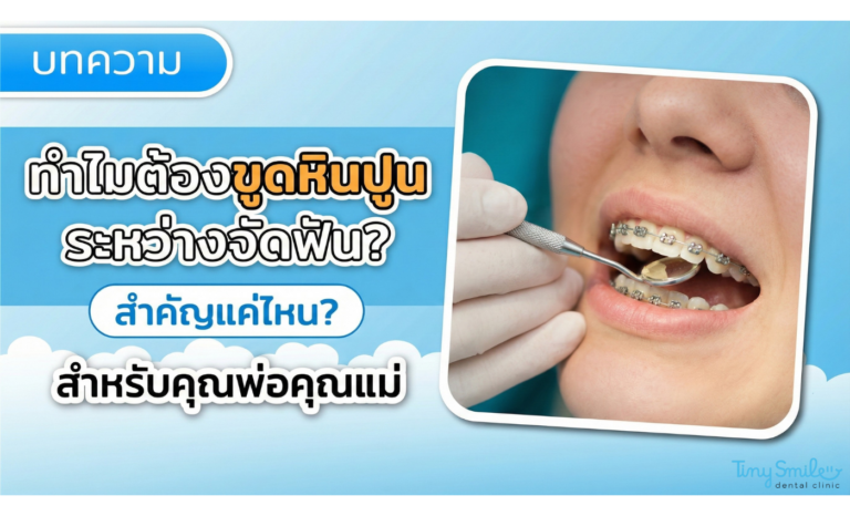 ทำไมต้องขูดหินปูนระหว่างจัดฟัน สำคัญแค่ไหน