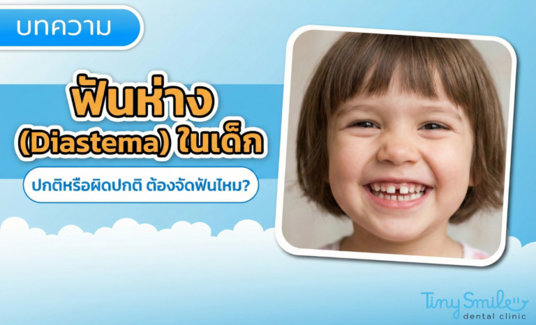 ฟันห่าง (Diastema) ในเด็ก ปกติหรือผิดปกติ ต้องจัดฟันไหม