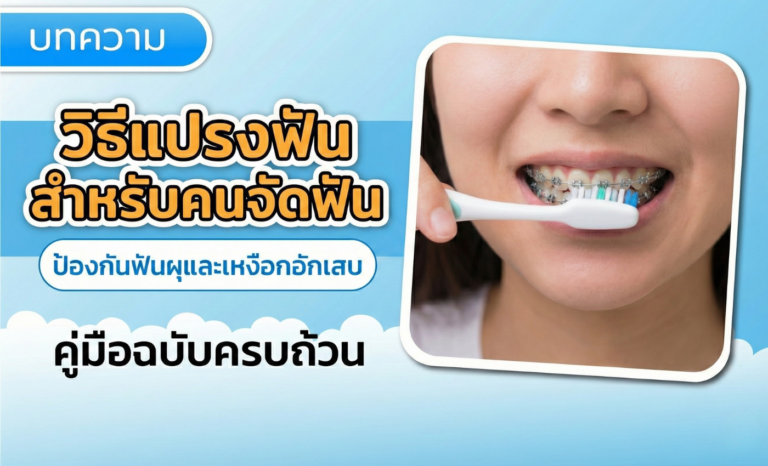 วิธีแปรงฟันสำหรับคนจัดฟัน ป้องกันฟันผุและเหงือกอักเสบ
