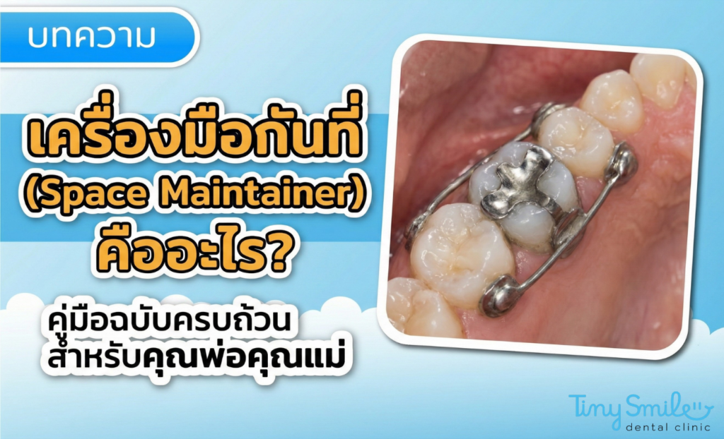 เครื่องมือกันที่ (Space Maintainer) คืออะไร