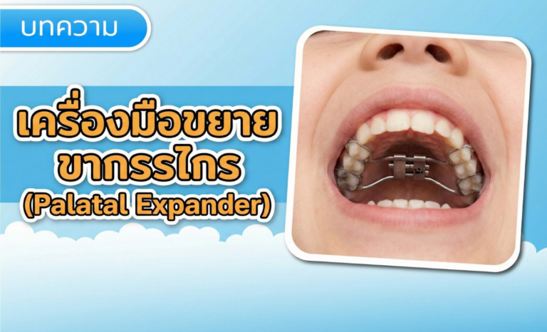 เครื่องมือขยายขากรรไกร (Palatal Expander) เจ็บไหม ใส่นานแค่ไหน