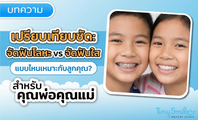 เปรียบเทียบชัด จัดฟันโลหะ vs จัดฟันใส แบบไหนเหมาะกับลูกคุณ